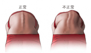 背部任何部位出现不对称均可能为脊柱侧弯.