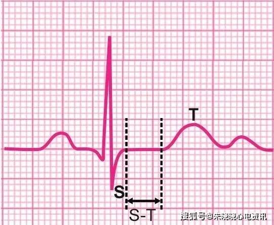 例如st段抬高型心肌梗死,变化非常典型,也有心电图没有任何明显的变化