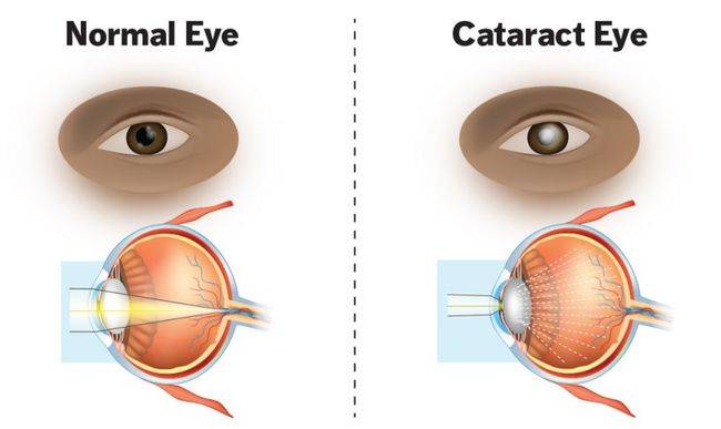 正常眼睛(左)和白内障(右),图源:cdn