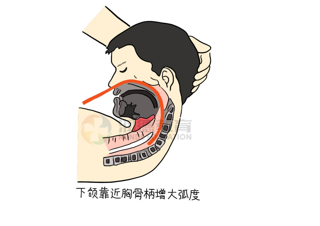 临床中,护士如何正确使用鼻饲法,将鼻导管经鼻腔插入胃内?