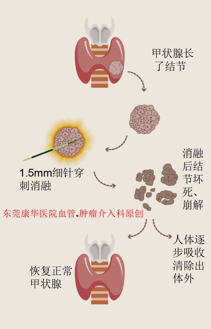 亿高说微创甲状腺结节微创消融治疗指引