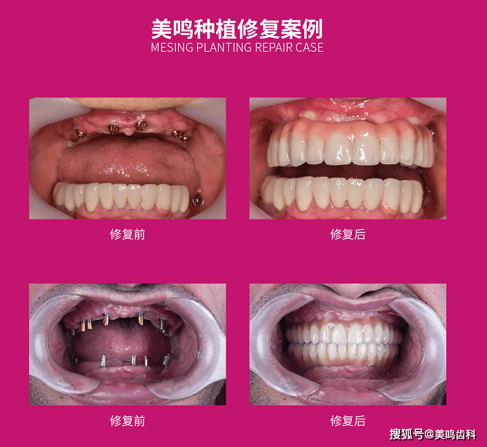 情暖重阳节献给父母晚年幸福的礼物种植牙