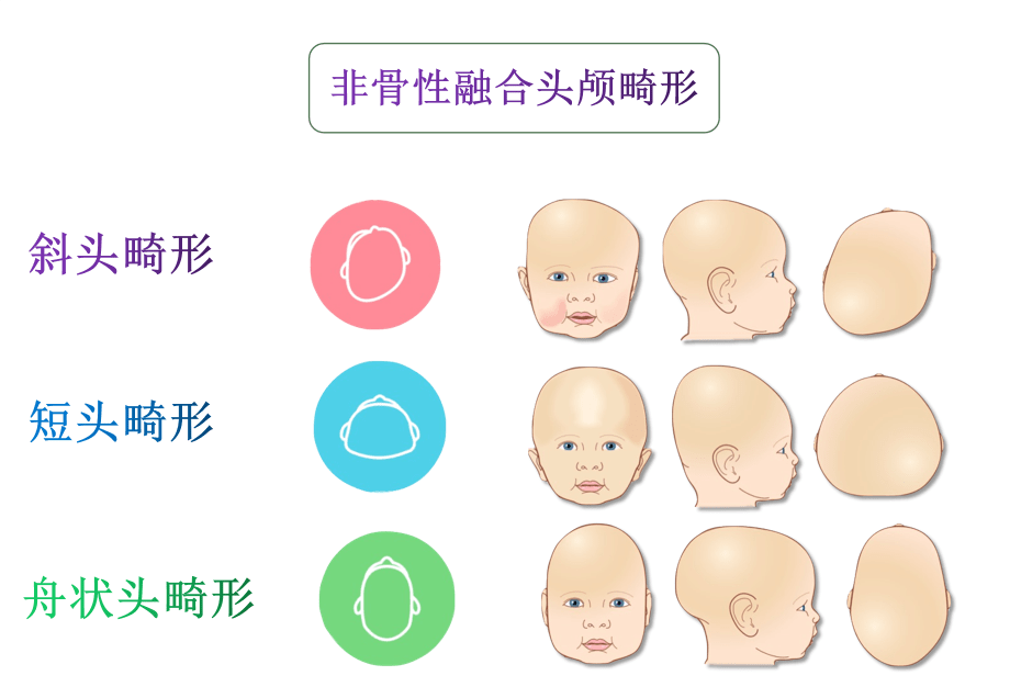 婴儿头颅畸形症状有哪些