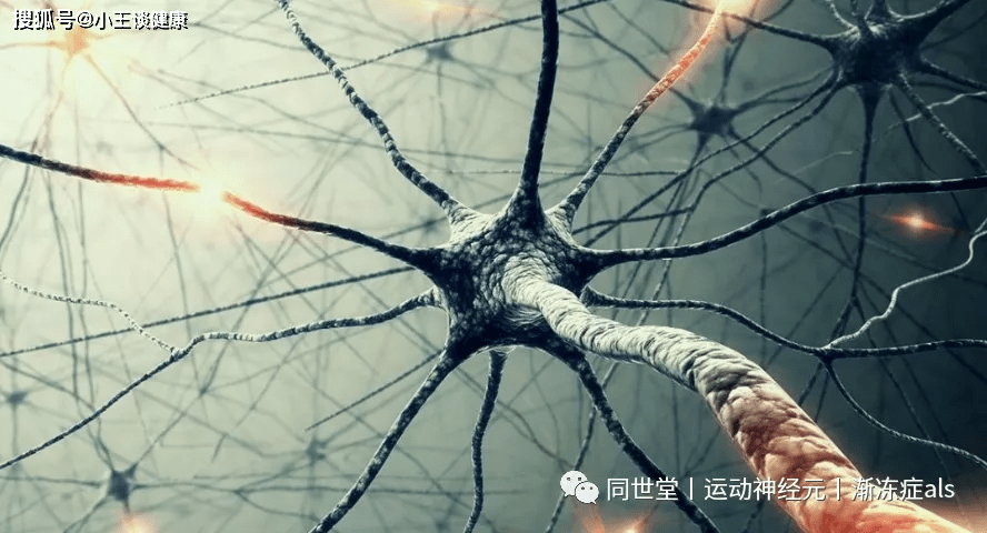 摘要:运动神经元病就是运动神经元受到损伤或损害,发病机制是选择性