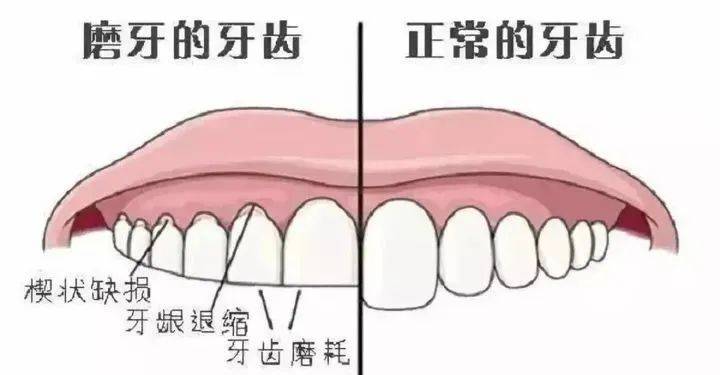 长期磨牙,会造成牙齿咬合面的磨损.