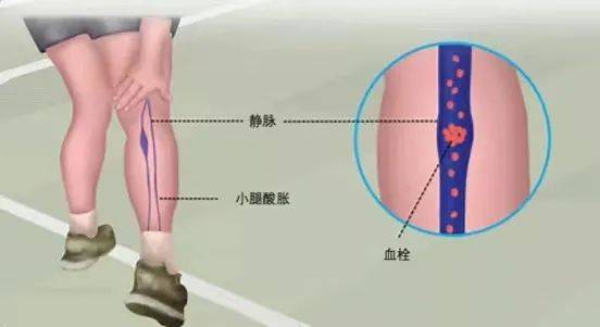 警惕小腿肌间静脉血栓形成莫轻视