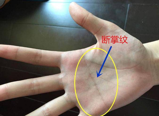 这种其实叫作假性断掌
