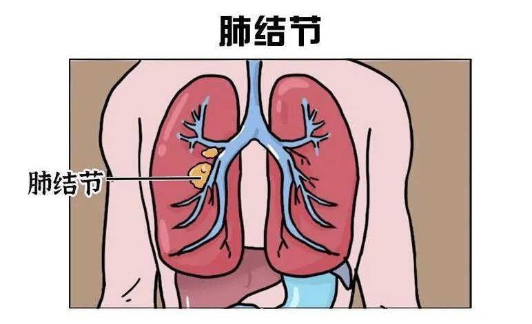 发现肺结节应该怎么办?_治疗_中药_五脏六腑