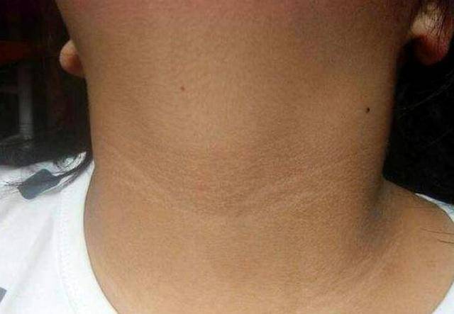 可能和长期受紫外线照射有关,造成脖子部位黑色素沉淀,想要缓解此症状