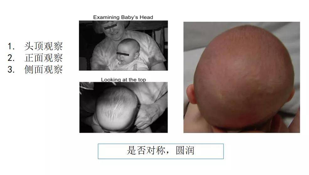 宇航博士矫正案例_婴儿_畸形_基本分析