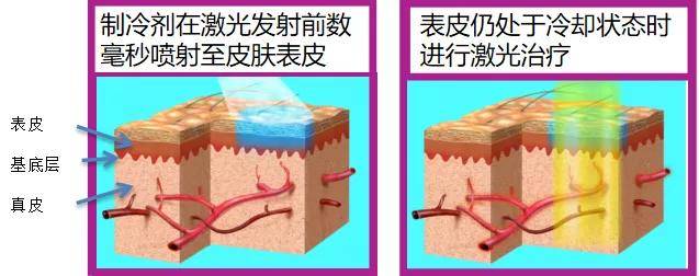 摆脱高原红去除红血丝看看vbeam595nm脉冲染料激光