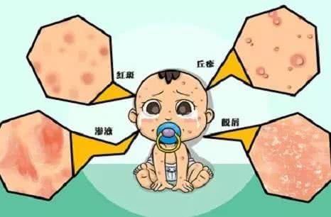 湿疹通常生长在婴儿的头部,脸颊,外耳,甚至整个面部和颈部.
