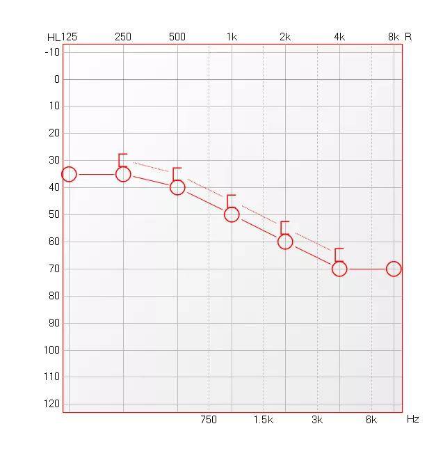 纯音测听结果:右侧气导平均听阈50db,左侧气导平均听阈88db左侧胆脂瘤