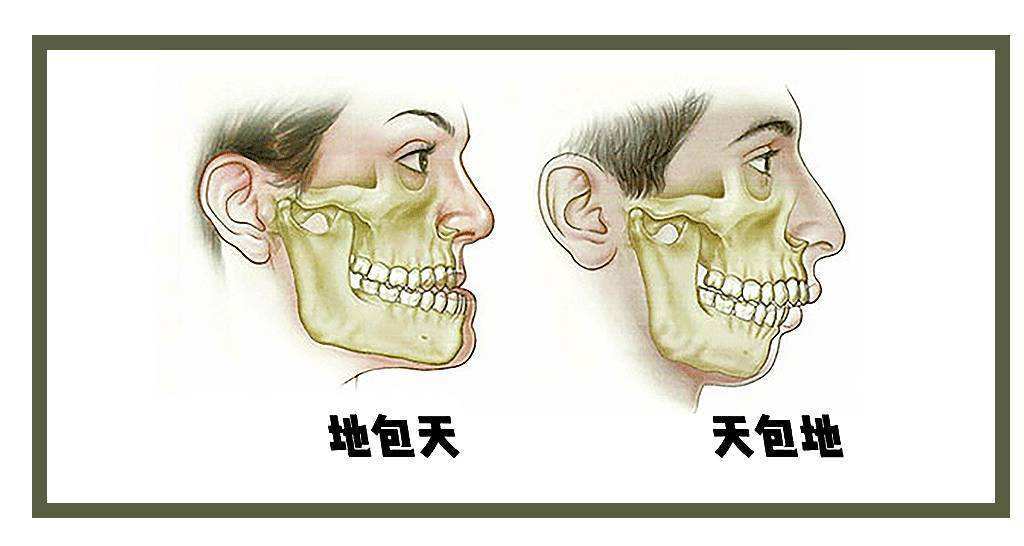 下颌角手术能够解决地包天问题吗