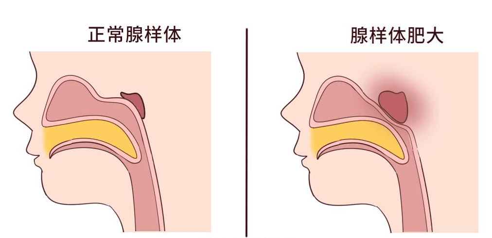 腺样体肥大必须做手术吗?(上)_治疗_免疫力_淋巴