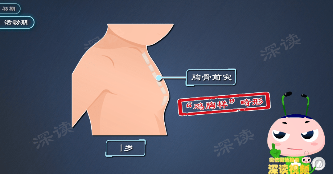 原创半岁宝宝爱哭闹竟是佝偻病孩子出现这些症状父母可要当心佝偻病了