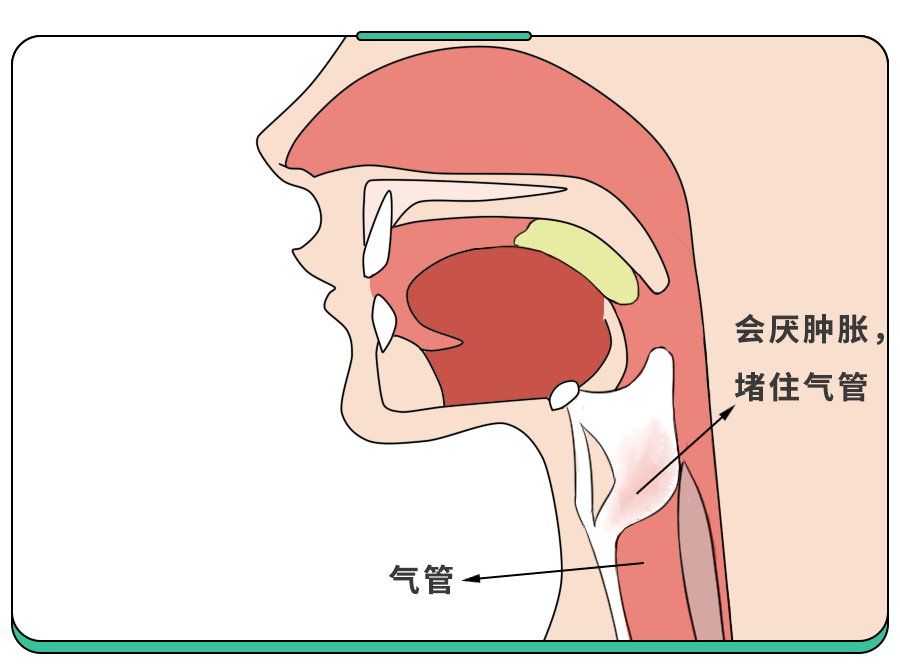 5岁娃嗓子疼进ICU！这病春季高发,重症率高,小孩大人都得防