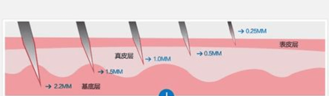 北京空美圣医:什么是中胚层疗法_皮肤_治疗_面部