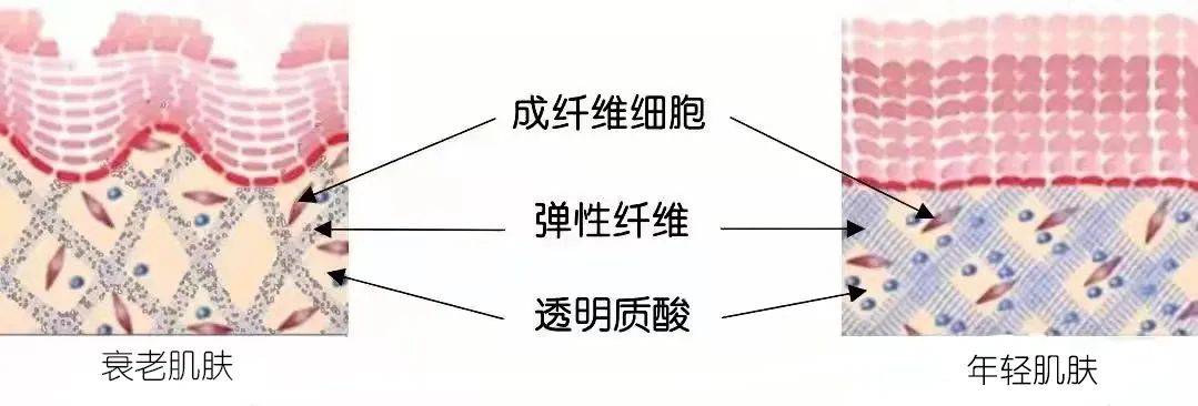 大量扩增自体成纤维细胞,注入真皮层,使真皮层的密度和厚度增加,扩增