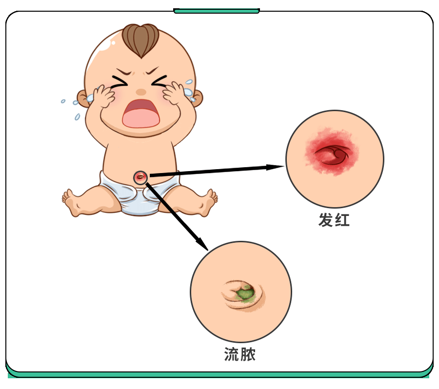 1月大婴儿因脐炎去世！小宝宝肚脐有这些＂异常＂,马上就医！