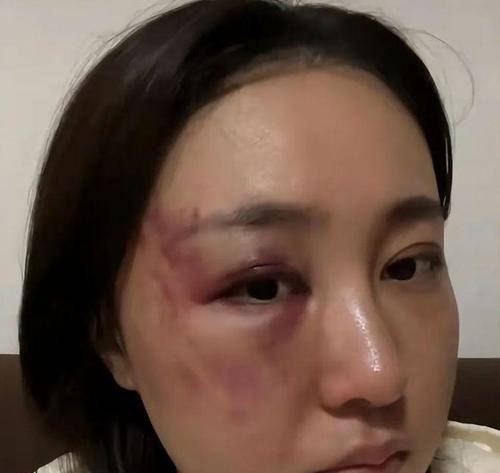 原创漂亮女星被老公家暴面目全非相恋3个月闪婚结婚7个月被打4次