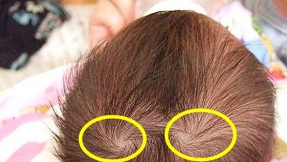 头旋是孩子毛发的生长方向和头皮形成一定的弧度造成的.