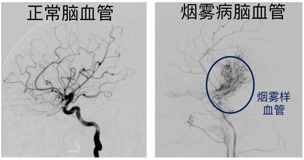 娃一学习就头疼，缘起“一团烟雾”