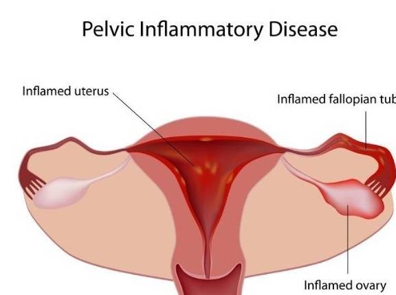自查一下：是不是这3种人之一？如果是，你可能会得盆腔炎