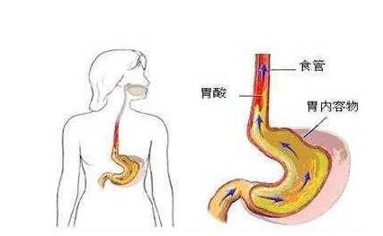 吃多了反酸、烧心？这有可能是胃食道反流哦