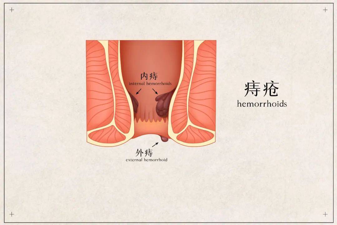 【医呼百应·健康有普】方松山：拯救“菊”部地区，不做有“痔”之士