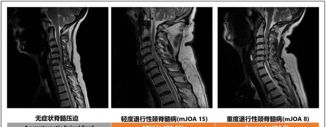 脊髓型颈椎病的诊治，一旦明白定断，建议及时手术治疗