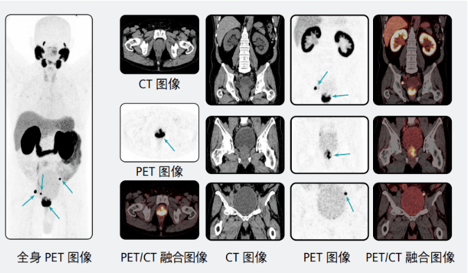 pet/ct，肿瘤诊断利器！