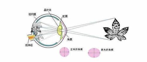 一、 曲率性散光：如果散光的度数较高，往往发生在角膜，这种散光通常是