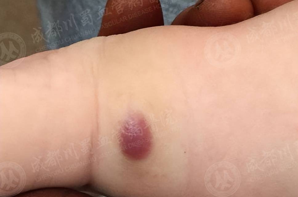血管瘤是先天性良性肿瘤或脉管畸形，多见于婴儿出生时或出生后不久，它