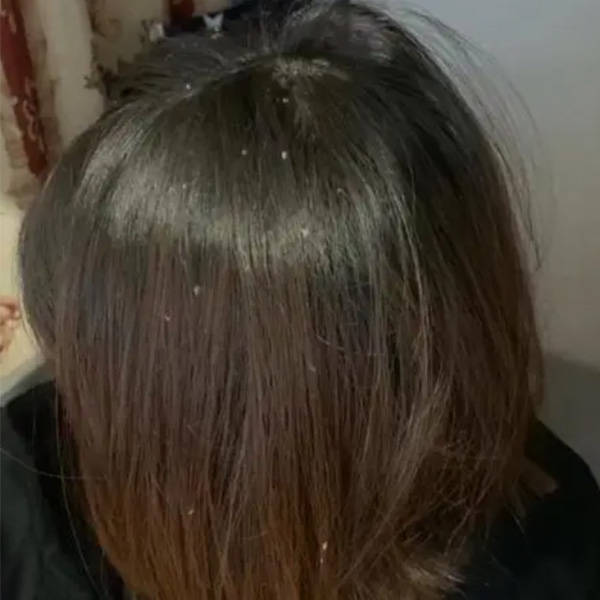 孕期头屑多是什么原因？？【多产品比较，找出适合你的头皮护理】