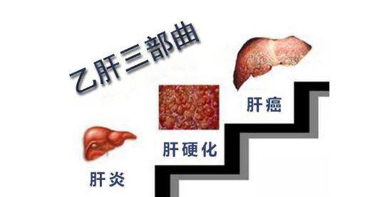 乙肝不可忽视的并发症早发现早治疗