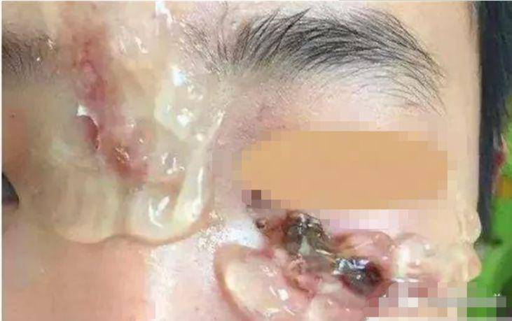 「宝宝」父母不去医院却用芦荟胶，这个知识一定要早知道2岁宝宝被剪刀划伤