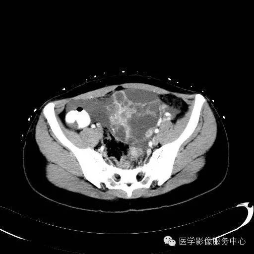 内胚窦瘤 来自搜狐网