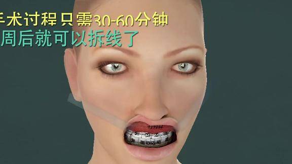3d动画龅牙凸嘴太丑怎么办微创手术能帮你