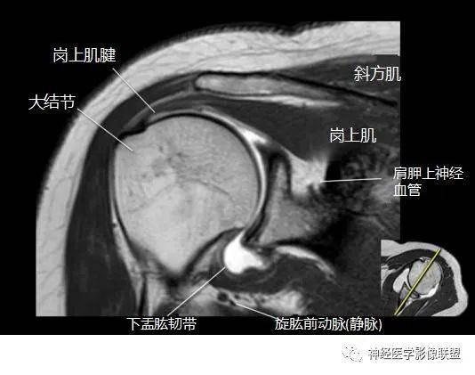 断层解剖 | 肩关节磁共振