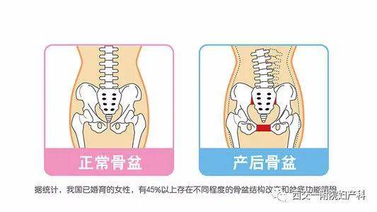骨盆前方两侧耻骨纤维软骨联合处,因外力而发生微小的错移,表现耻骨联