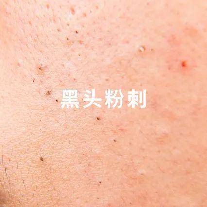 干货分享脂肪粒抠不出脂肪闭口和黑头其实是一家人