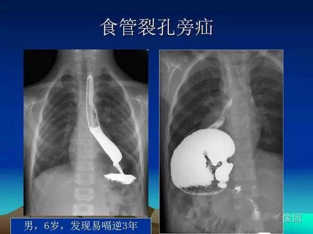 膈疝影像学表现