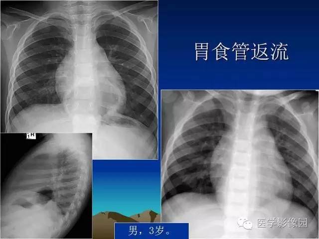 膈疝影像学表现