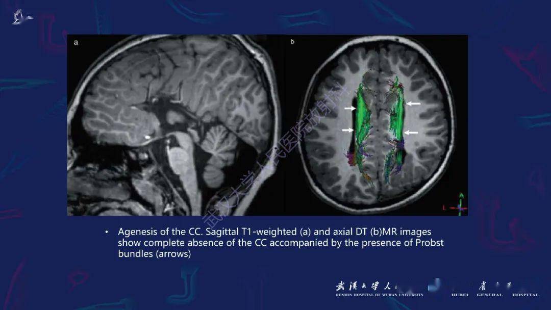 胼胝体病变影像诊断
