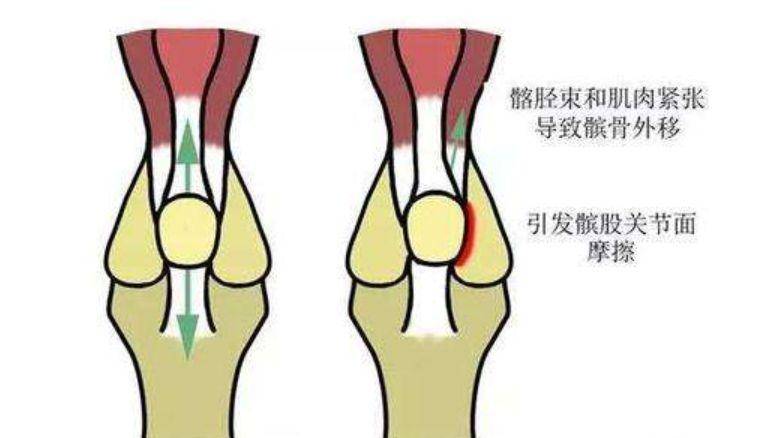 骨科医生不会告诉你膝盖疼的11种原因,表现和针对治疗