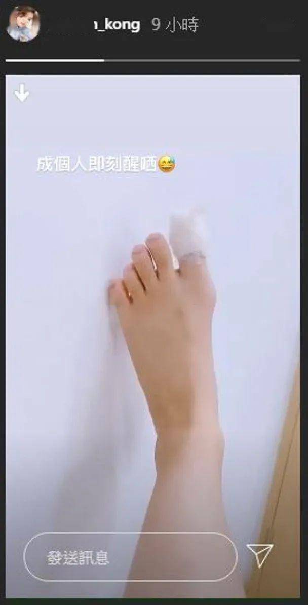 江嘉敏客串《降魔的2.0》引关注,大晒脚趾受伤惨照!