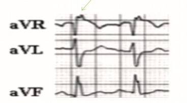 rbbb 心电图表现4:avr导联r波增高 急性右室负荷增加和右心扩张,其额