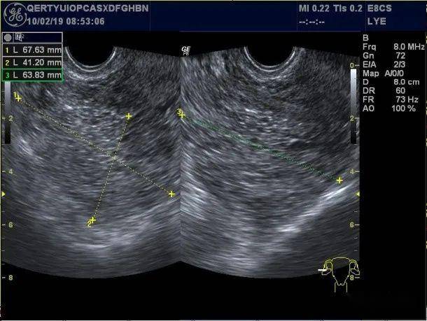 考考你:卵巢内的高回声,除了畸胎瘤你还知道啥?_超声