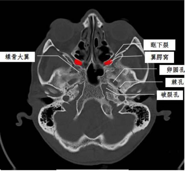 一文搞懂复杂解剖翼腭窝